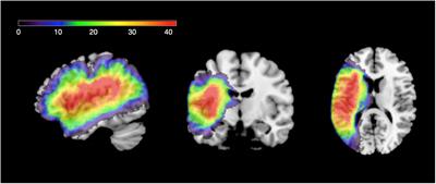 Common predictors of spoken and written language performance in aphasia, alexia, and agraphia